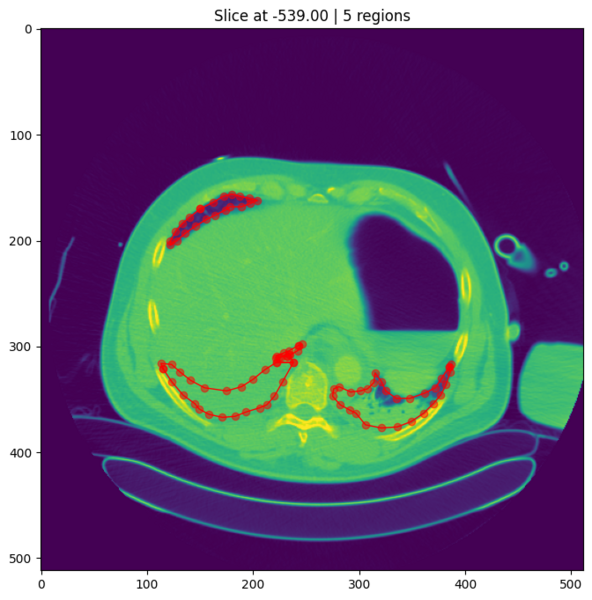 Computertomographiebild einer Lunge mit Markierungen auffälliger Bereiche